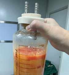庄河水动力吸脂手术要做多久？